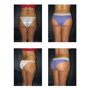 Brazilian-Butt-Lift-New-York