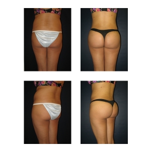 Brazilian-Butt-Lift-New-York