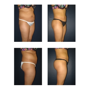 Brazilian-Butt-Lift-New-York