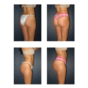 Brazilian-Butt-Lift-New-York