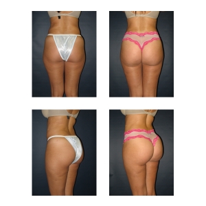 Brazilian-Butt-Lift-New-York