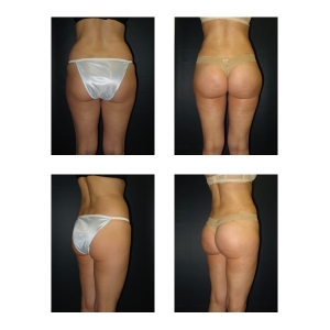 Brazilian-Butt-Lift-New-York