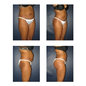 Brazilian-Butt-Lift-New-York