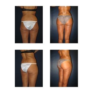Brazilian-Butt-lift-New-York-City
