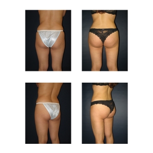 Brazilian-Butt-lift-New-York
