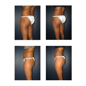 Brazilian-Butt-lift-New-York