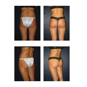 Butt-Augmentation-NYC