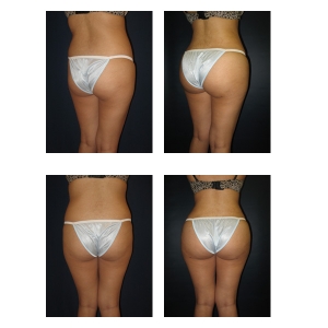 Butt-Augmentation-NYC