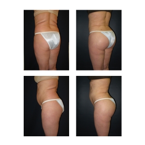 Butt-Augmentation-New-York-City