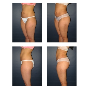 Butt-Augmentation-New-York-City