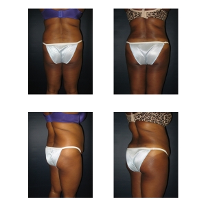 Butt-Augmentation-New-York