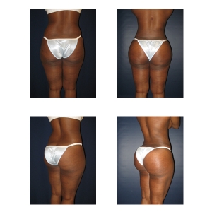 Butt-Augmentation-New-York