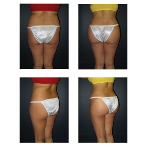 Butt-Augmentation-New-York