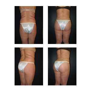 Butt-Implants-New-York-City