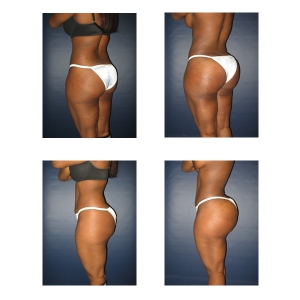 Butt-Implants-New-York-City
