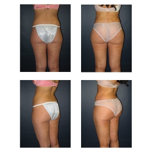 Butt-Lift-New-York-City