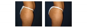Buttock-Augmentation-and-Lift