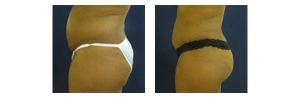 Buttock-Augmentation-and-Lift