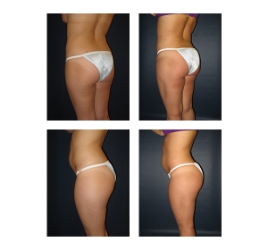 Buttock-Augmentation-and-Lift