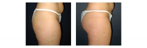 Buttock-Augmentation-and-Lift