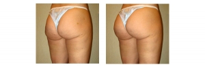 Buttock-Augmentation-and-Lift