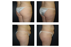 Buttock-Augmentation-and-Lift