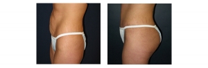 Buttock-Augmentation-and-Lift-8