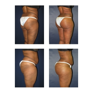 Brazilian Butt Lift