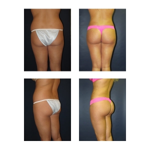 Brazilian Butt Lift