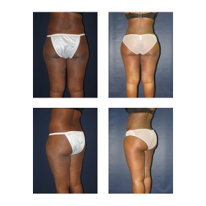 Brazilian Butt Lift