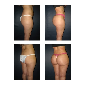 Brazilian Butt Lift