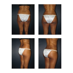 Brazilian Butt Lift