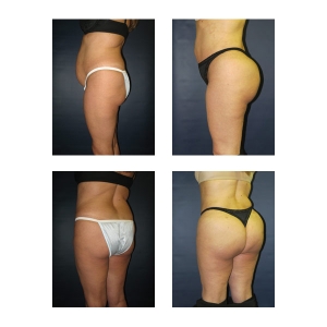 Brazilian Butt Lift