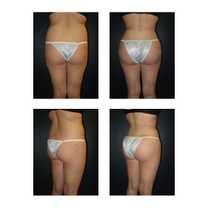 Brazilian Butt Lift