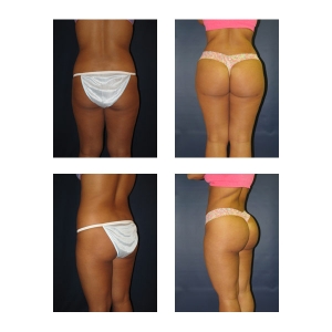 Brazilian Butt Lift
