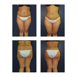 Brazilian Butt Lift