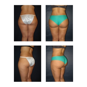 Brazilian Butt Lift