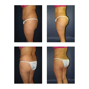 Brazilian Butt Lift