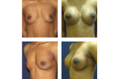 Breast Augmentation