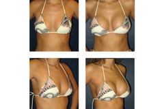 Breast-Augmentation