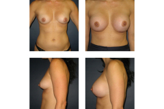 Breast-Augmentation