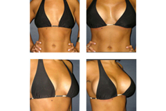 Breast-Augmentation New York City