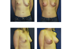 Breast-Augmentation-NYC-Patient