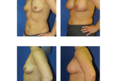 Breast-Augmentation-NYC-Patient