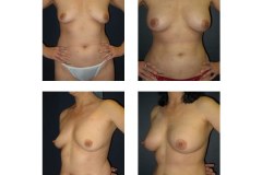 Breast-Augmentation-New-York-City