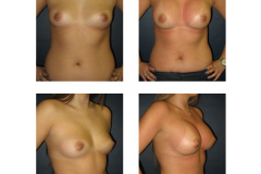 Breast-Augmentation-New-York-City