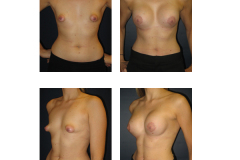 Breast-Augmentation-New-York-City