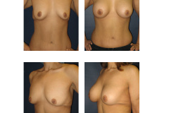 Breast-Augmentation-New-York-City