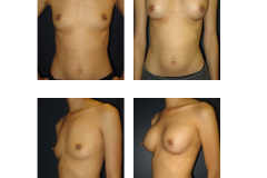 Breast-Augmentation-New-York-City