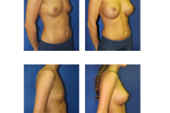 Breast-Augmentation-New-York-Patient